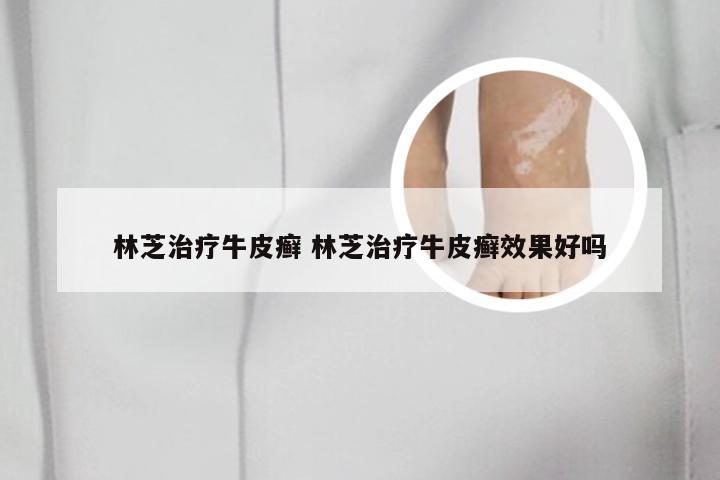 林芝治疗牛皮癣 林芝治疗牛皮癣效果好吗