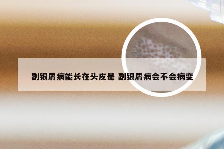 副银屑病能长在头皮是 副银屑病会不会病变