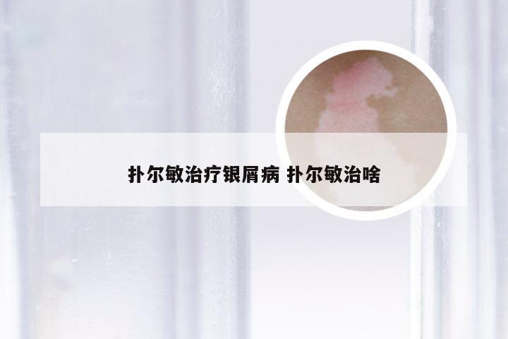 扑尔敏治疗银屑病 扑尔敏治啥