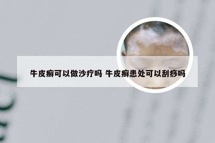 牛皮癣可以做沙疗吗 牛皮癣患处可以刮痧吗