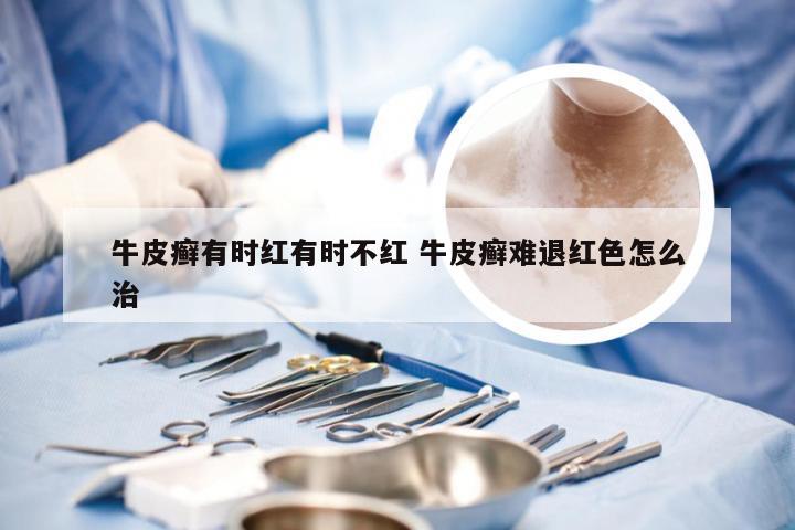 牛皮癣有时红有时不红 牛皮癣难退红色怎么治