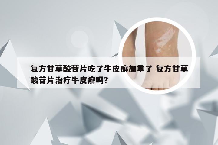 复方甘草酸苷片吃了牛皮癣加重了 复方甘草酸苷片治疗牛皮癣吗?