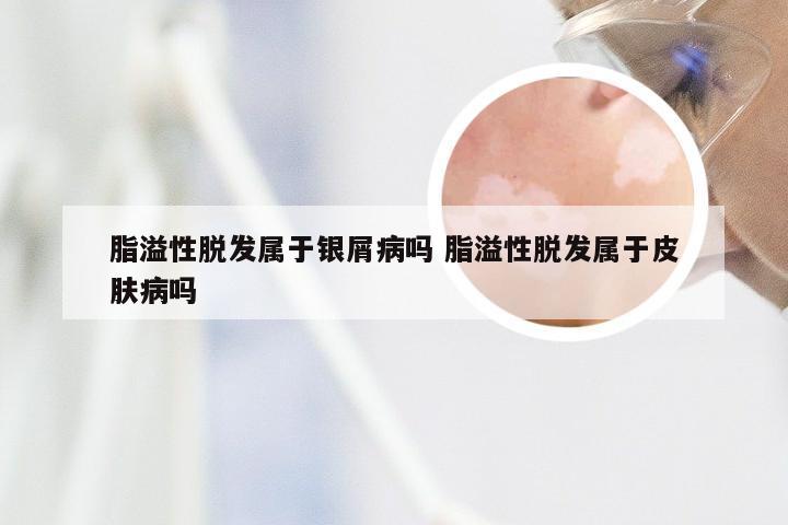 脂溢性脱发属于银屑病吗 脂溢性脱发属于皮肤病吗