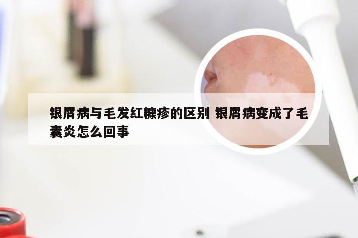 银屑病与毛发红糠疹的区别 银屑病变成了毛囊炎怎么回事
