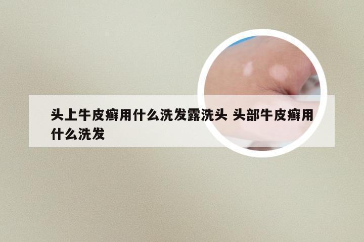 头上牛皮癣用什么洗发露洗头 头部牛皮癣用什么洗发
