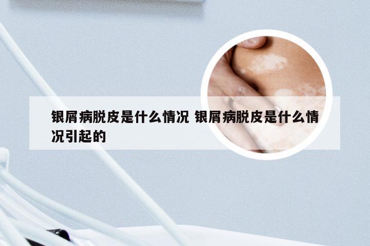银屑病脱皮是什么情况 银屑病脱皮是什么情况引起的