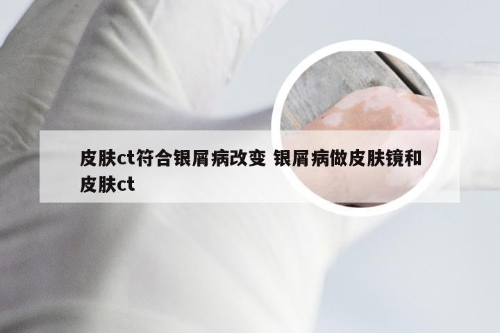 皮肤ct符合银屑病改变 银屑病做皮肤镜和皮肤ct