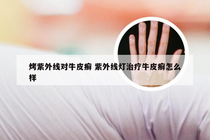 烤紫外线对牛皮癣 紫外线灯治疗牛皮癣怎么样