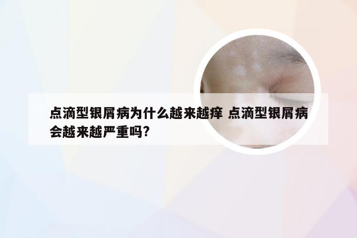 点滴型银屑病为什么越来越痒 点滴型银屑病会越来越严重吗?