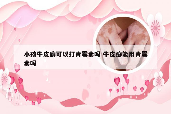 小孩牛皮癣可以打青霉素吗 牛皮癣能用青霉素吗