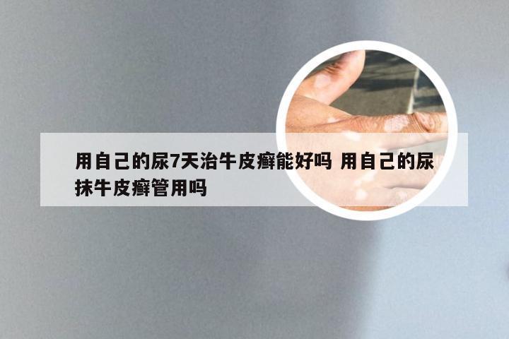 用自己的尿7天治牛皮癣能好吗 用自己的尿抹牛皮癣管用吗