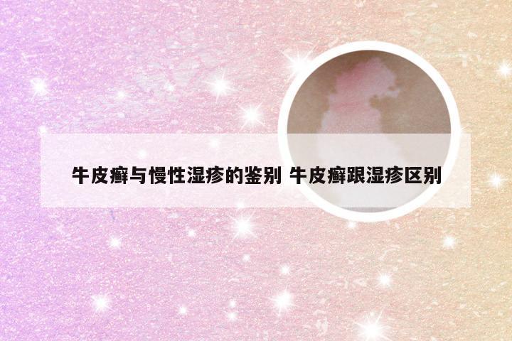 牛皮癣与慢性湿疹的鉴别 牛皮癣跟湿疹区别
