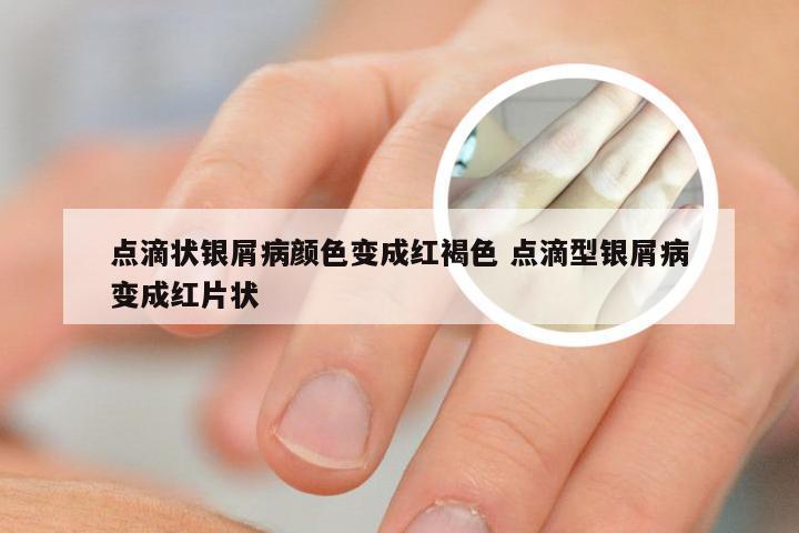 点滴状银屑病颜色变成红褐色 点滴型银屑病变成红片状