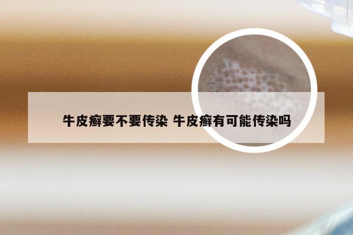牛皮癣要不要传染 牛皮癣有可能传染吗