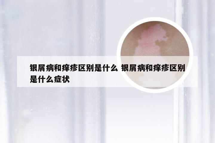 银屑病和痒疹区别是什么 银屑病和痒疹区别是什么症状