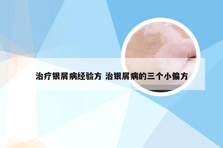 治疗银屑病经验方 治银屑病的三个小偏方