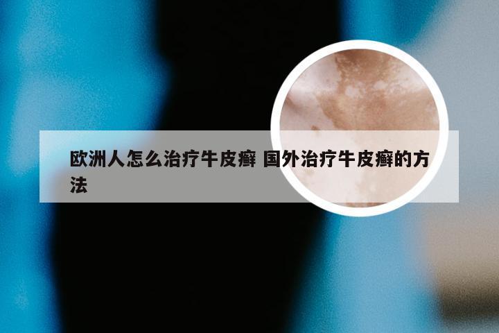 欧洲人怎么治疗牛皮癣 国外治疗牛皮癣的方法