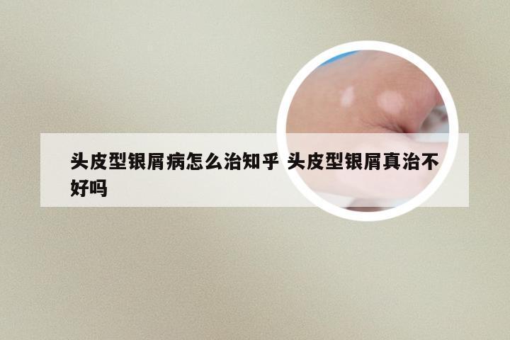 头皮型银屑病怎么治知乎 头皮型银屑真治不好吗