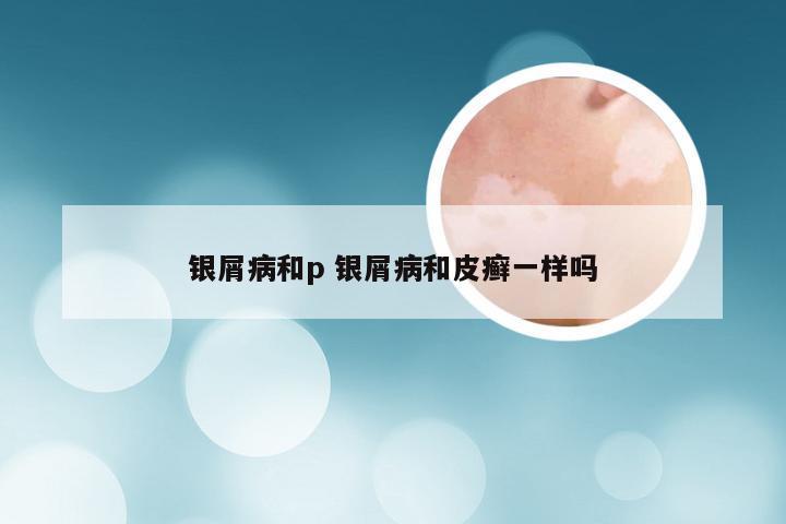 银屑病和p 银屑病和皮癣一样吗