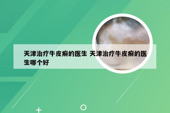 天津治疗牛皮癣的医生 天津治疗牛皮癣的医生哪个好