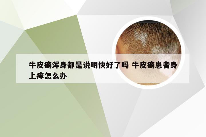 牛皮癣浑身都是说明快好了吗 牛皮癣患者身上痒怎么办