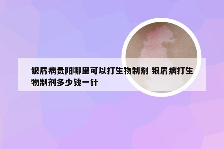 银屑病贵阳哪里可以打生物制剂 银屑病打生物制剂多少钱一针