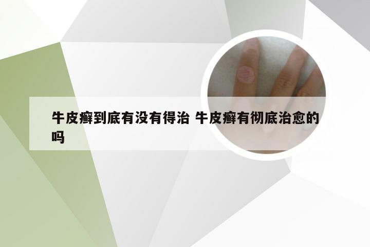 牛皮癣到底有没有得治 牛皮癣有彻底治愈的吗