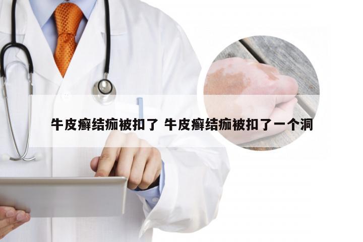 牛皮癣结痂被扣了 牛皮癣结痂被扣了一个洞