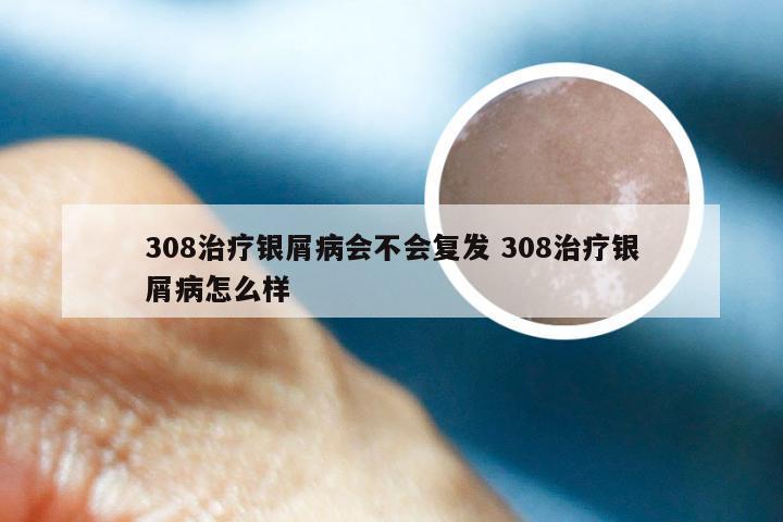 308治疗银屑病会不会复发 308治疗银屑病怎么样