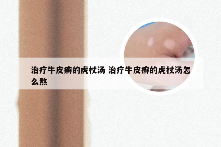 治疗牛皮癣的虎杖汤 治疗牛皮癣的虎杖汤怎么熬