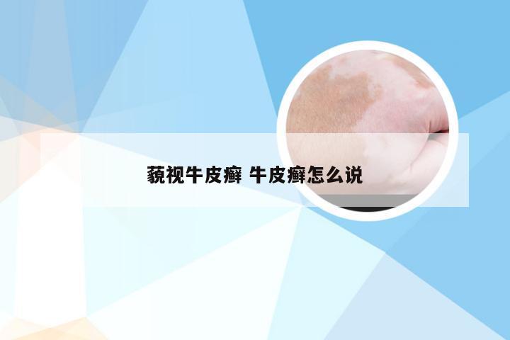 藐视牛皮癣 牛皮癣怎么说