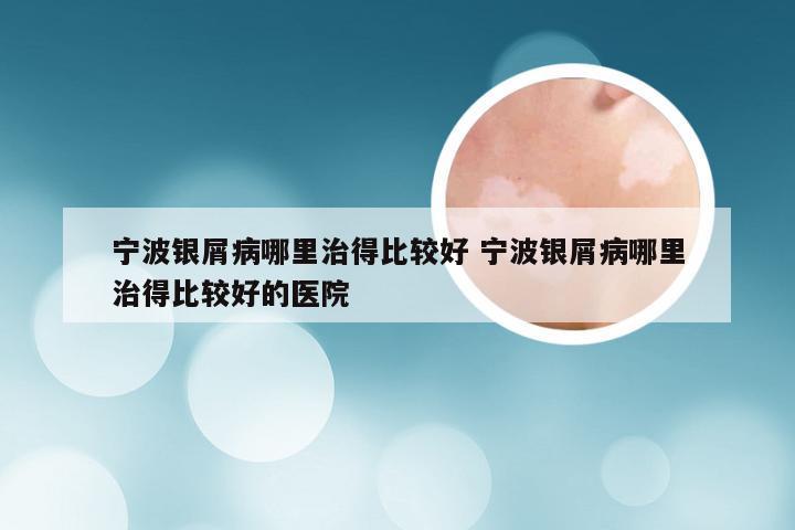 宁波银屑病哪里治得比较好 宁波银屑病哪里治得比较好的医院