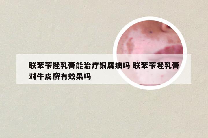 联苯苄挫乳膏能治疗银屑病吗 联苯苄唑乳膏对牛皮癣有效果吗