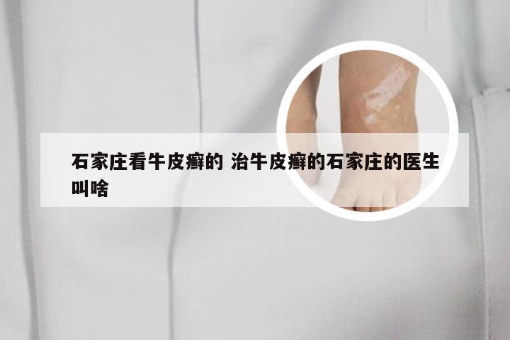 石家庄看牛皮癣的 治牛皮癣的石家庄的医生叫啥
