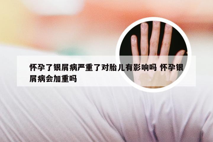 怀孕了银屑病严重了对胎儿有影响吗 怀孕银屑病会加重吗