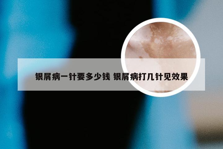 银屑病一针要多少钱 银屑病打几针见效果