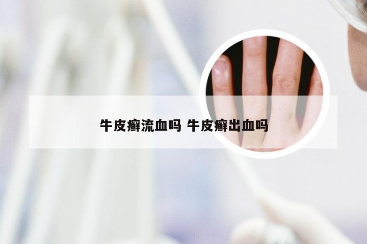 牛皮癣流血吗 牛皮癣出血吗