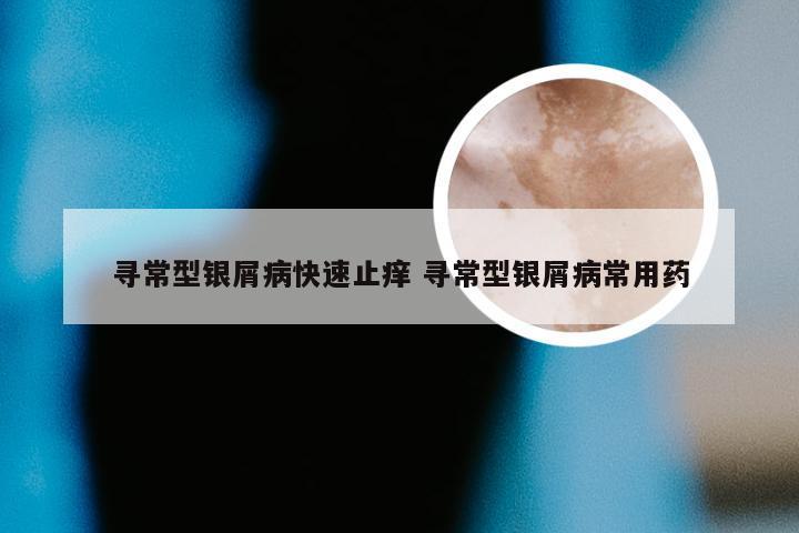 寻常型银屑病快速止痒 寻常型银屑病常用药