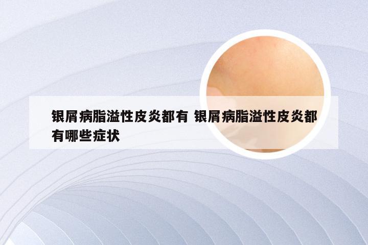 银屑病脂溢性皮炎都有 银屑病脂溢性皮炎都有哪些症状