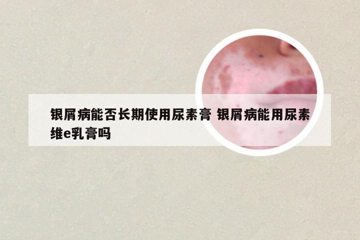 银屑病能否长期使用尿素膏 银屑病能用尿素维e乳膏吗