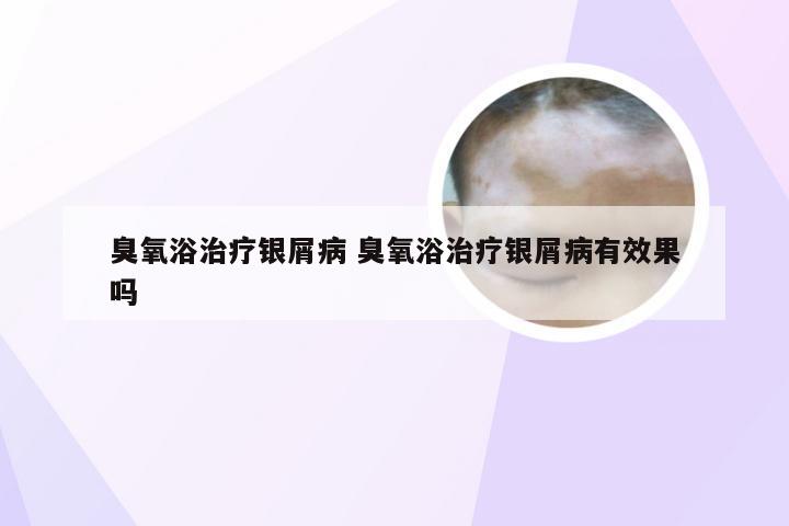 臭氧浴治疗银屑病 臭氧浴治疗银屑病有效果吗