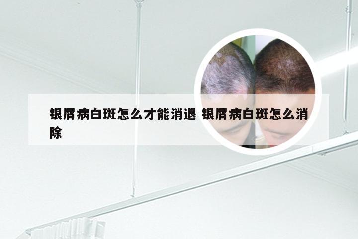 银屑病白斑怎么才能消退 银屑病白斑怎么消除