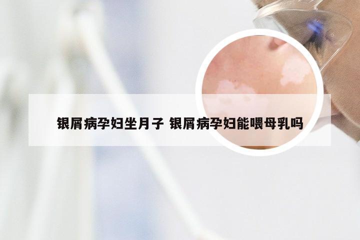 银屑病孕妇坐月子 银屑病孕妇能喂母乳吗