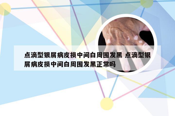点滴型银屑病皮损中间白周围发黑 点滴型银屑病皮损中间白周围发黑正常吗