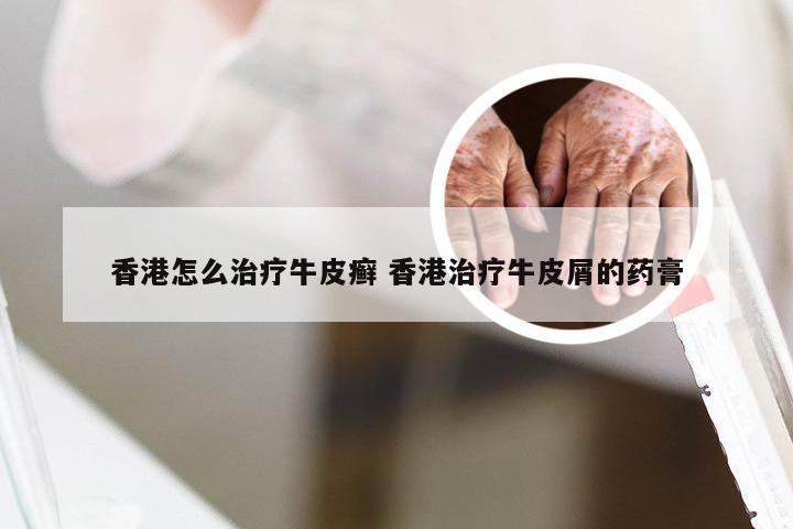 香港怎么治疗牛皮癣 香港治疗牛皮屑的药膏