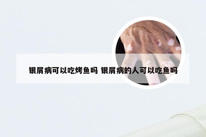 银屑病可以吃烤鱼吗 银屑病的人可以吃鱼吗