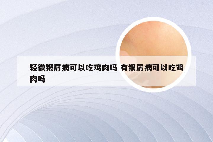 轻微银屑病可以吃鸡肉吗 有银屑病可以吃鸡肉吗