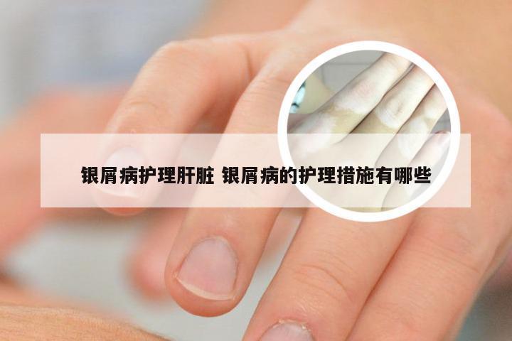 银屑病护理肝脏 银屑病的护理措施有哪些