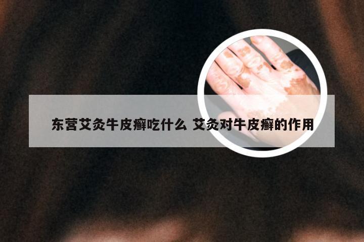 东营艾灸牛皮癣吃什么 艾灸对牛皮癣的作用