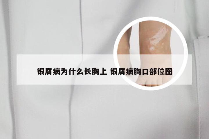 银屑病为什么长胸上 银屑病胸口部位图